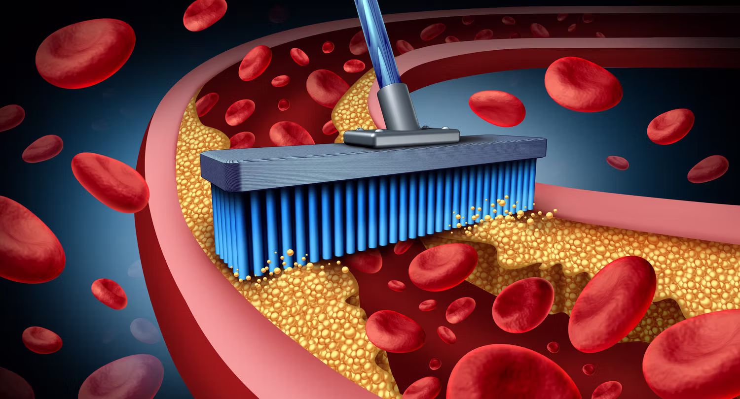 Illustration of a brush clearing deposits from inside a blood vessel